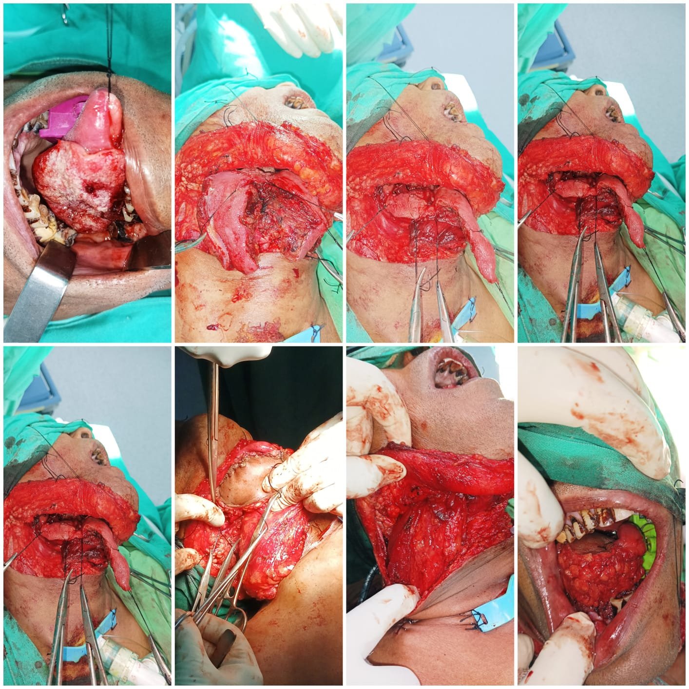 tongue cancer management